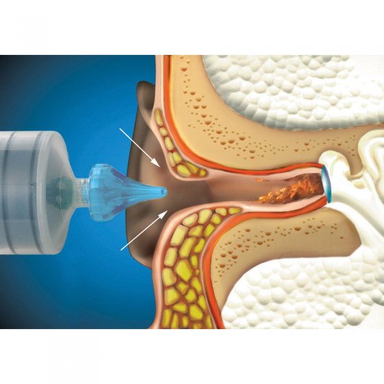 Ohrenschmalz-Entfernungsspritze 