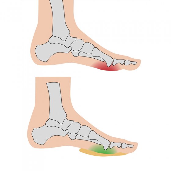 Coussinet d'avant-pied « supersoft » 