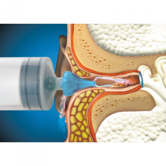 Ohrenschmalz-Entfernungsspritze 