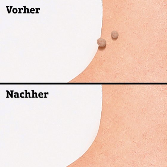 Patchs pour verrues pédiculées 
