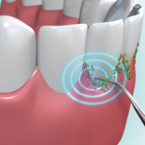 Système de nettoyage dentaire  "Dental Pic Sonic" 