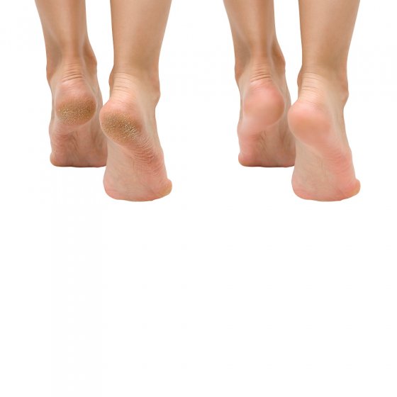 Spray contre les mycoses des pieds et des ongles 