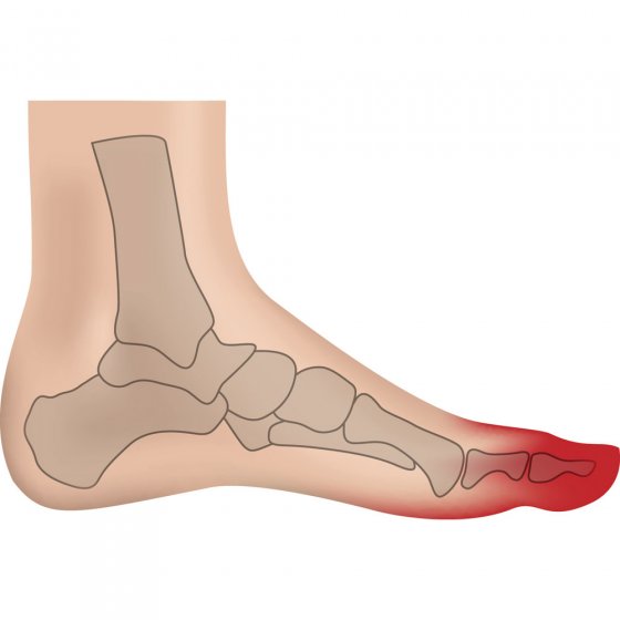 Orthèse de nuit pour hallux valgus 