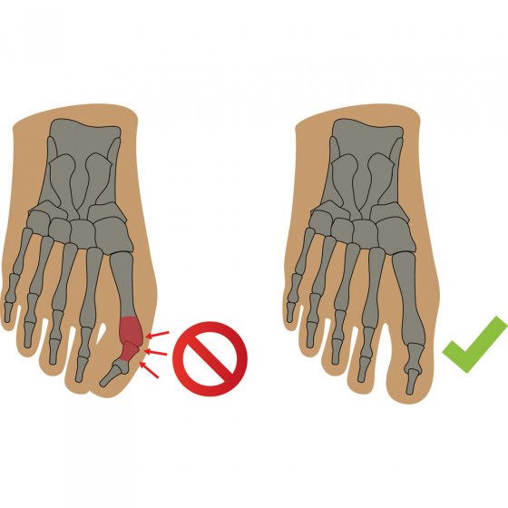 Orthèse de nuit pour hallux valgus 